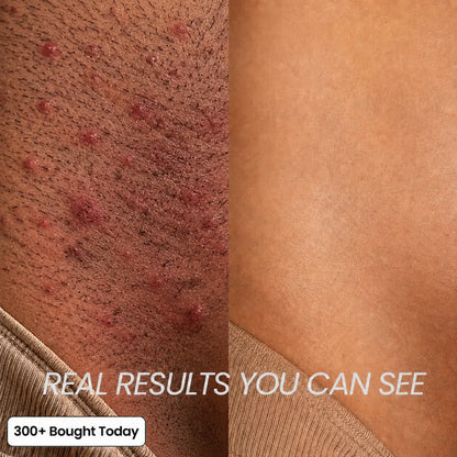 Novara's Anti-Hair Growth Oil
